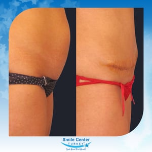 Before and after cosmetic surgery at Smile Center Turkey