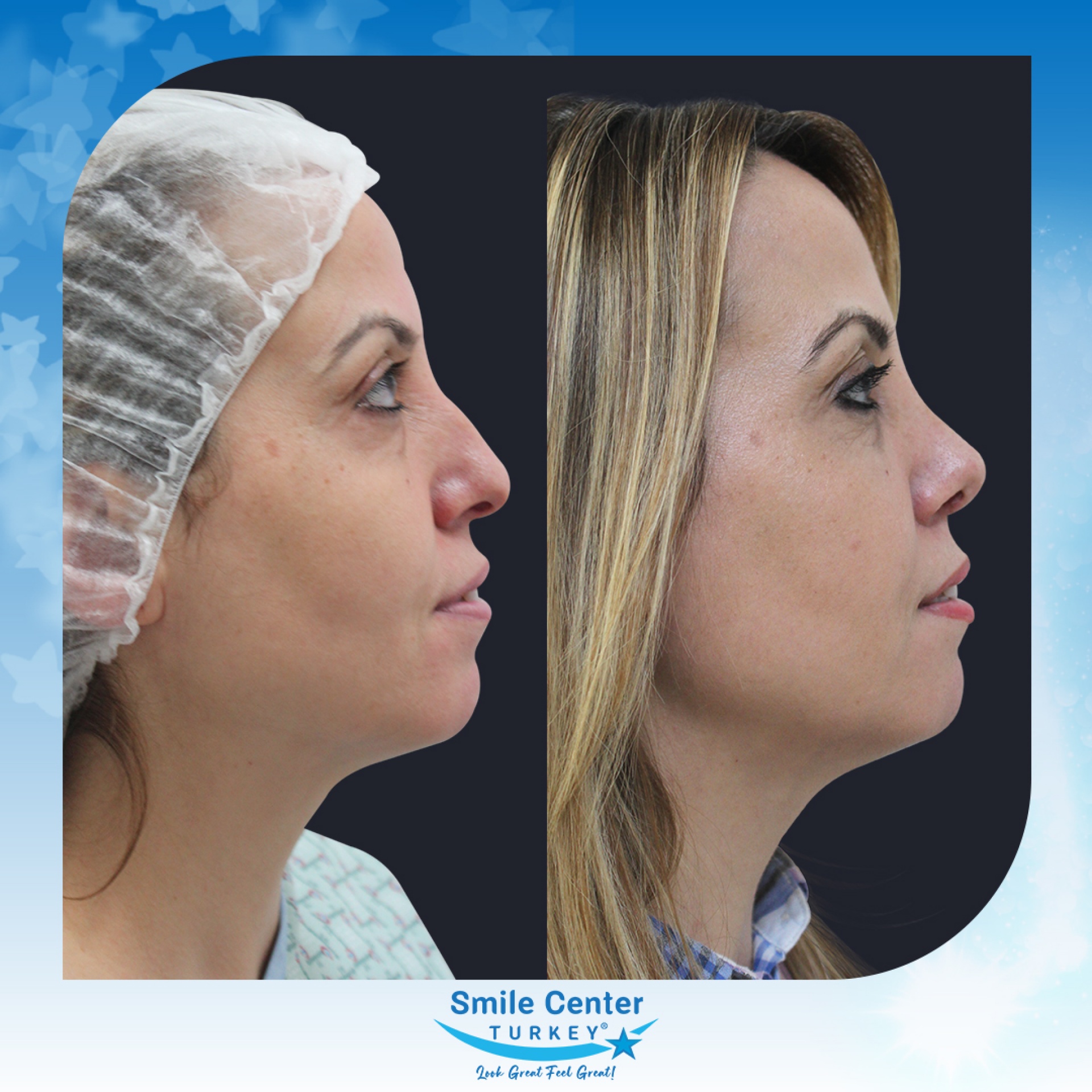 Before and after cosmetic surgery at Smile Center Turkey