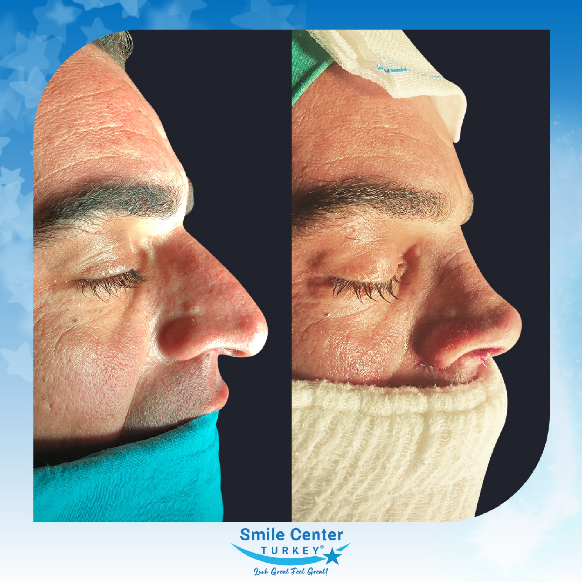 Before and after cosmetic surgery at Smile Center Turkey