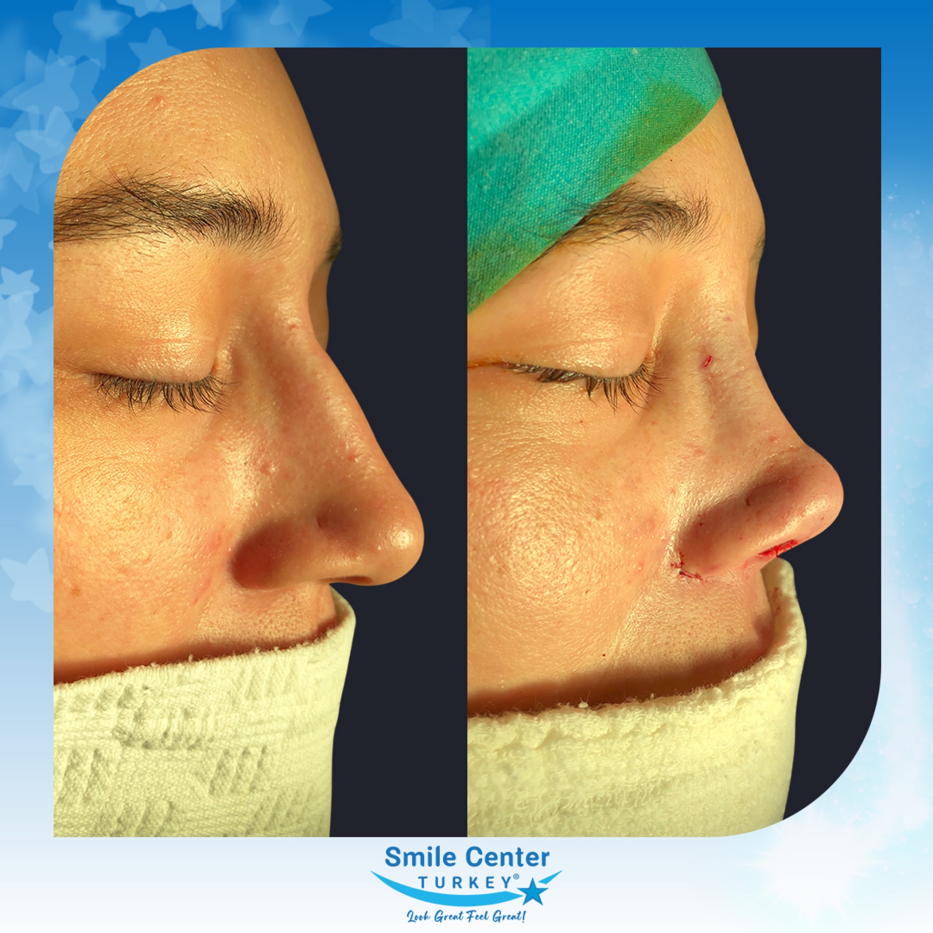 Before and after cosmetic surgery at Smile Center Turkey