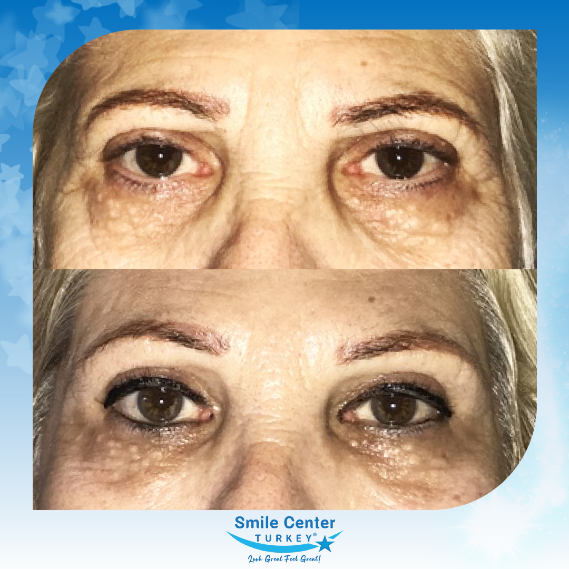 Before and after cosmetic surgery at Smile Center Turkey