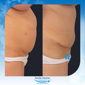 Before and after cosmetic surgery at Smile Center Turkey