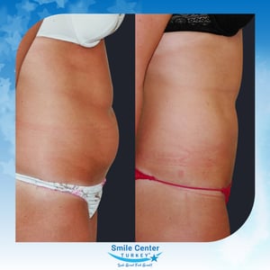 Before and after cosmetic surgery at Smile Center Turkey