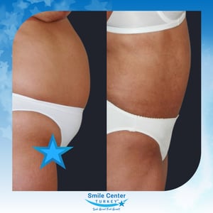 Before and after cosmetic surgery at Smile Center Turkey