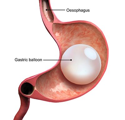 intra-gastric-balloon