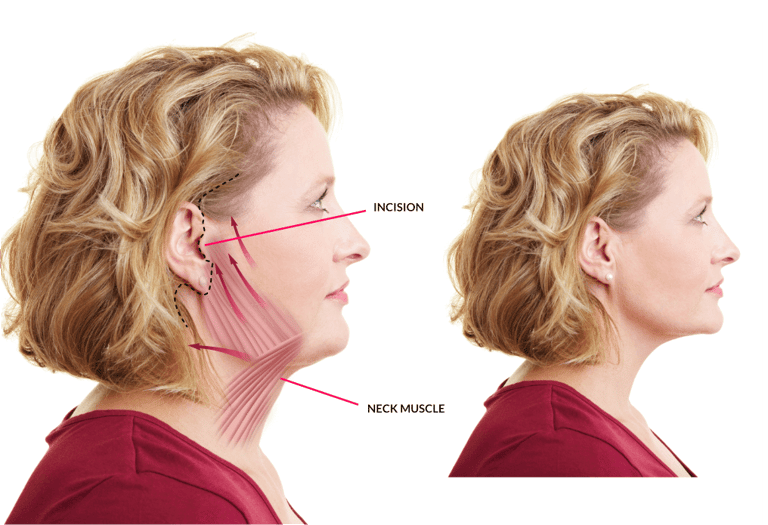 Necklift