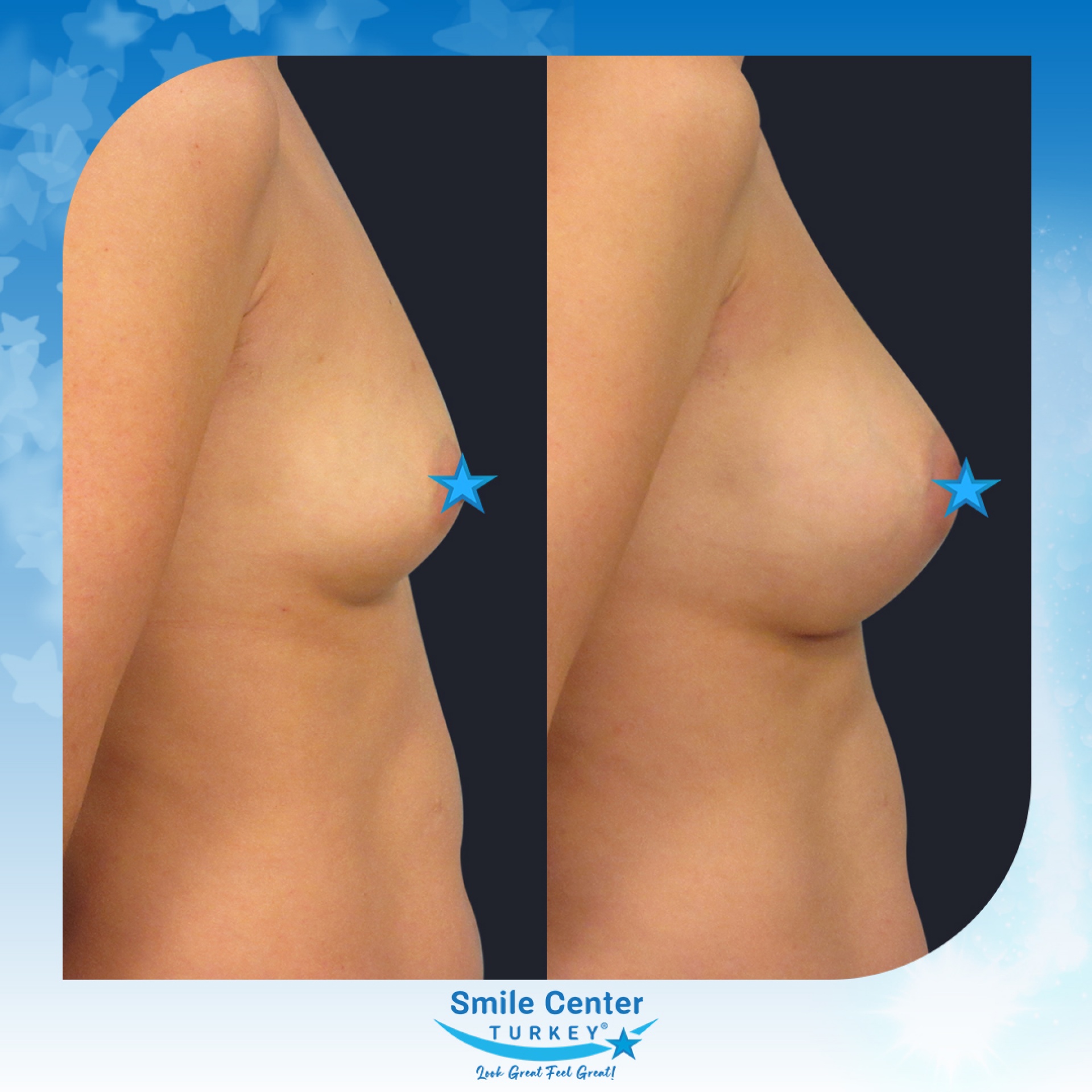 Before and after cosmetic surgery at Smile Center Turkey