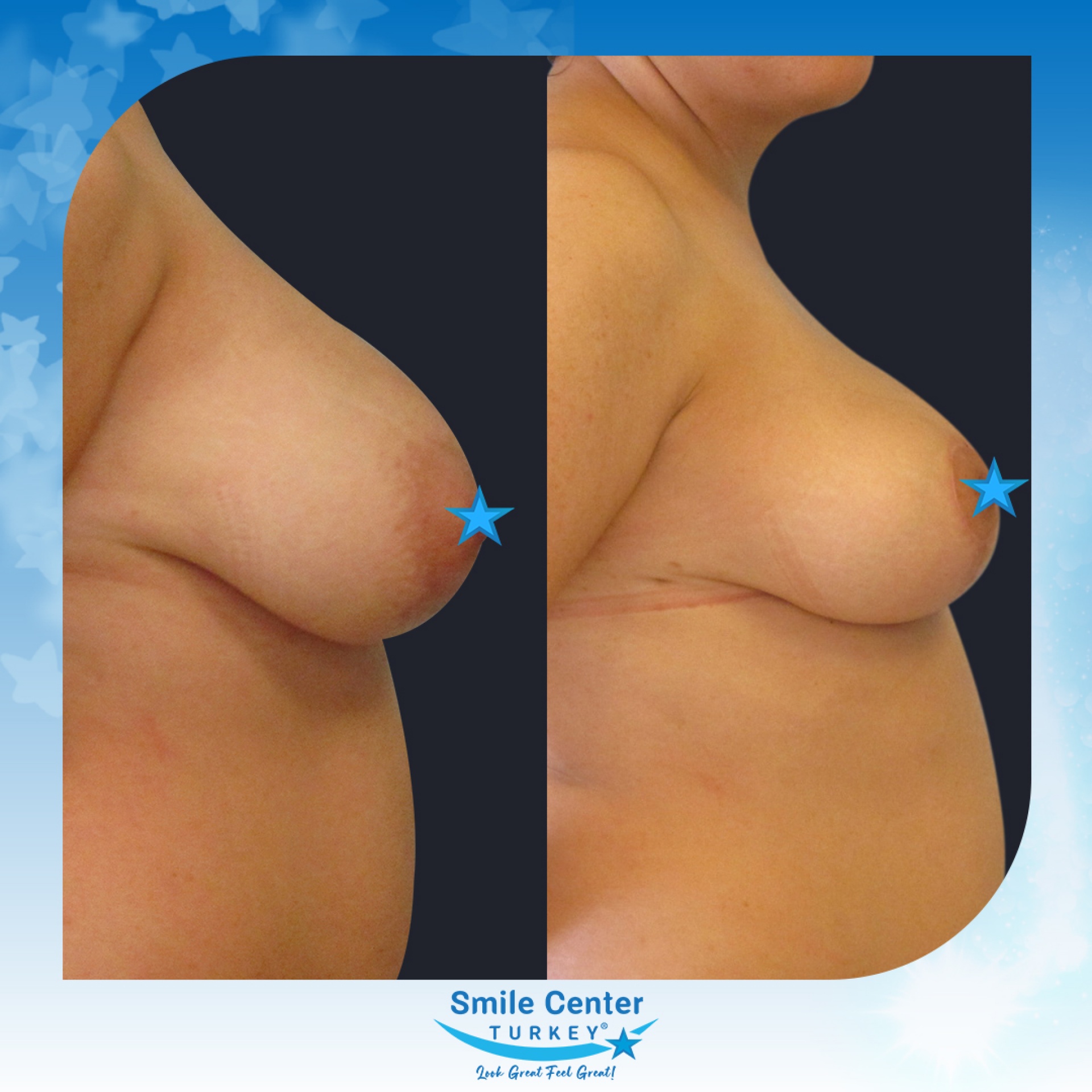 Before and after cosmetic surgery at Smile Center Turkey