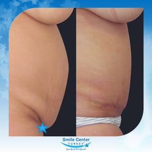 Before and after cosmetic surgery at Smile Center Turkey