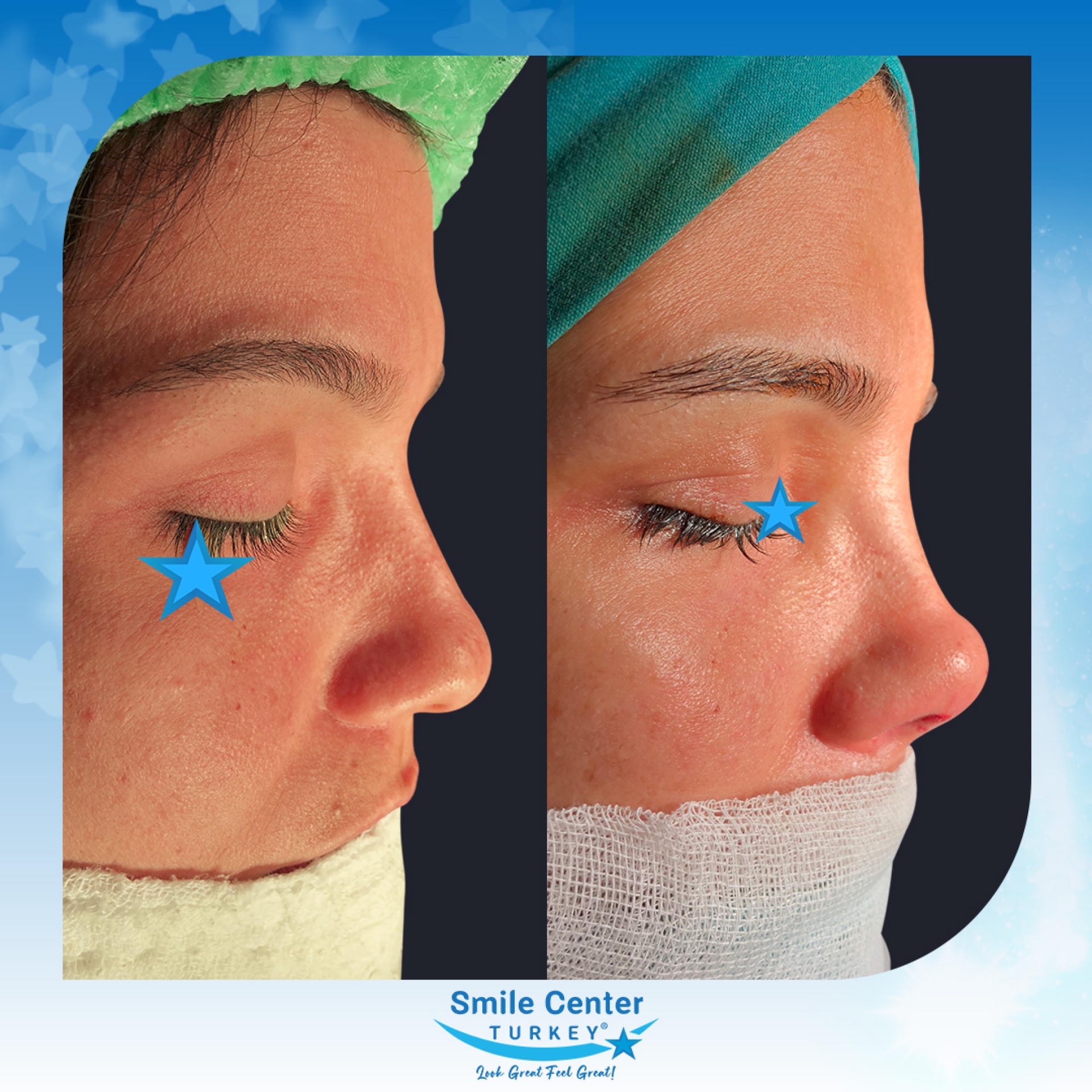 Before and after cosmetic surgery at Smile Center Turkey