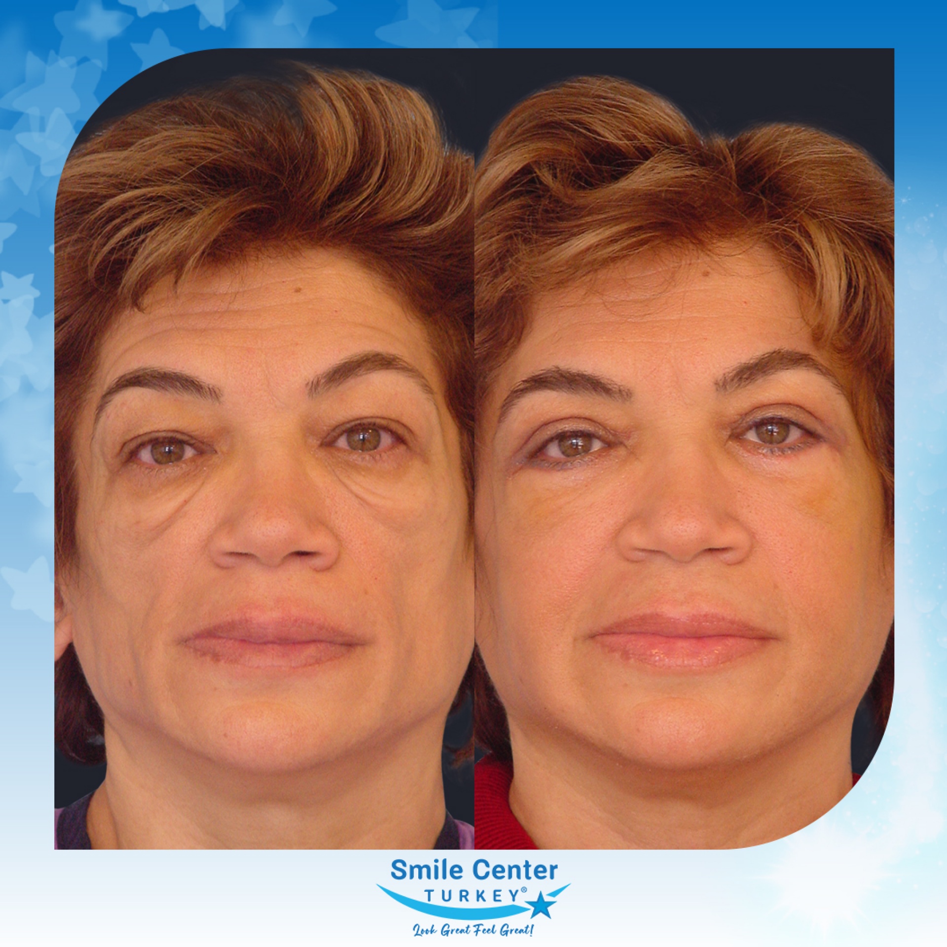 Before and after cosmetic surgery at Smile Center Turkey