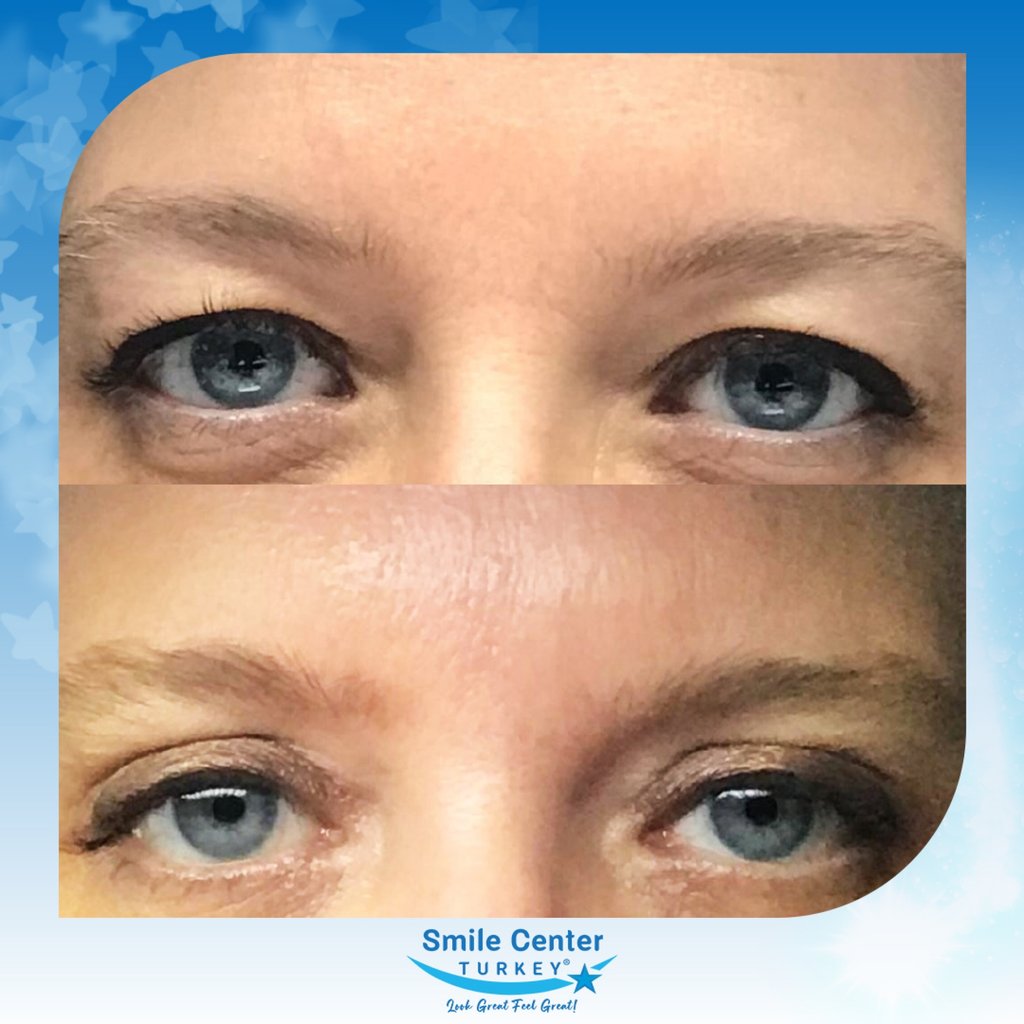 Before and after cosmetic surgery at Smile Center Turkey