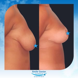 Before and after cosmetic surgery at Smile Center Turkey
