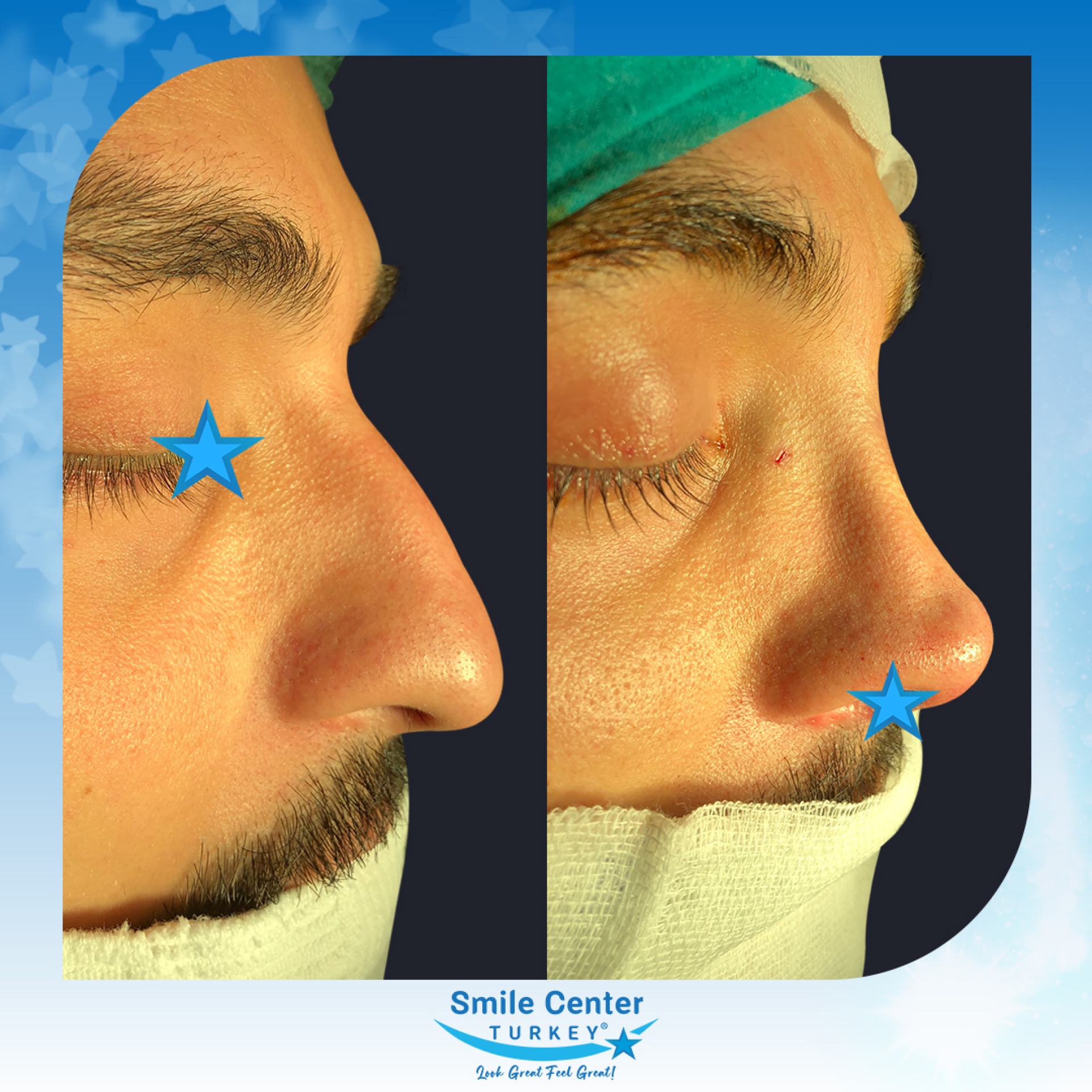Before and after cosmetic surgery at Smile Center Turkey