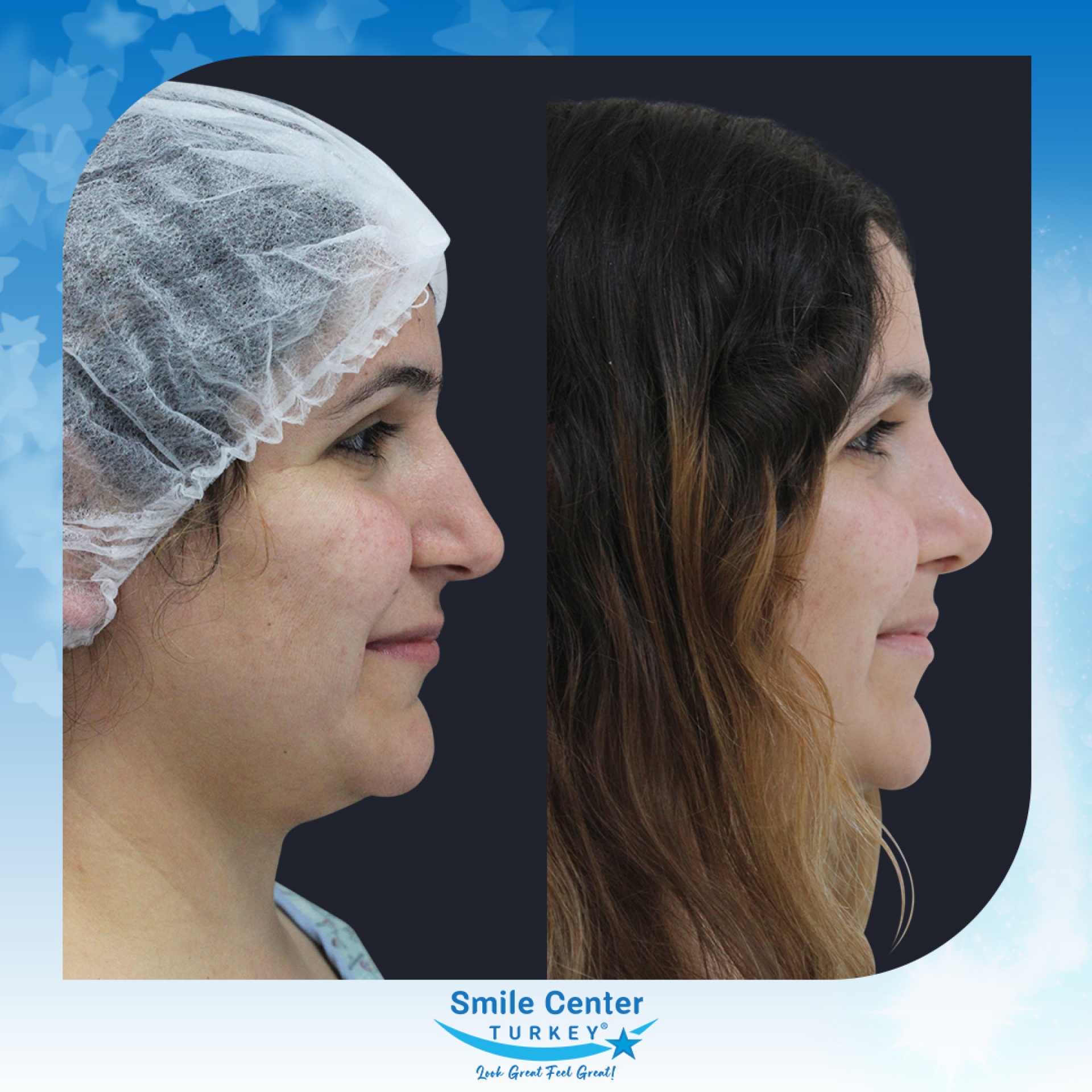 Before and after cosmetic surgery at Smile Center Turkey