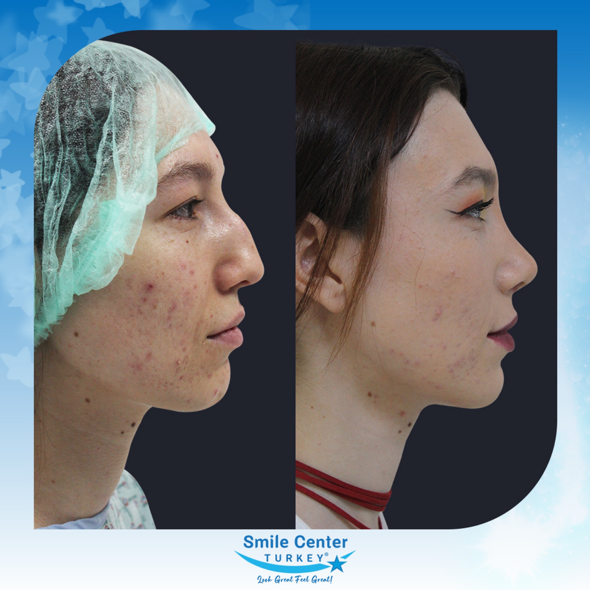 Before and after cosmetic surgery at Smile Center Turkey