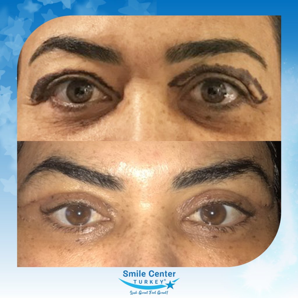 Before and after cosmetic surgery at Smile Center Turkey