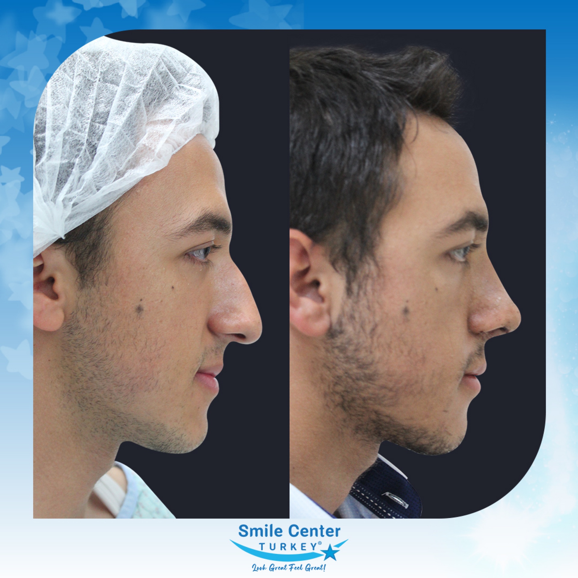 Before and after cosmetic surgery at Smile Center Turkey