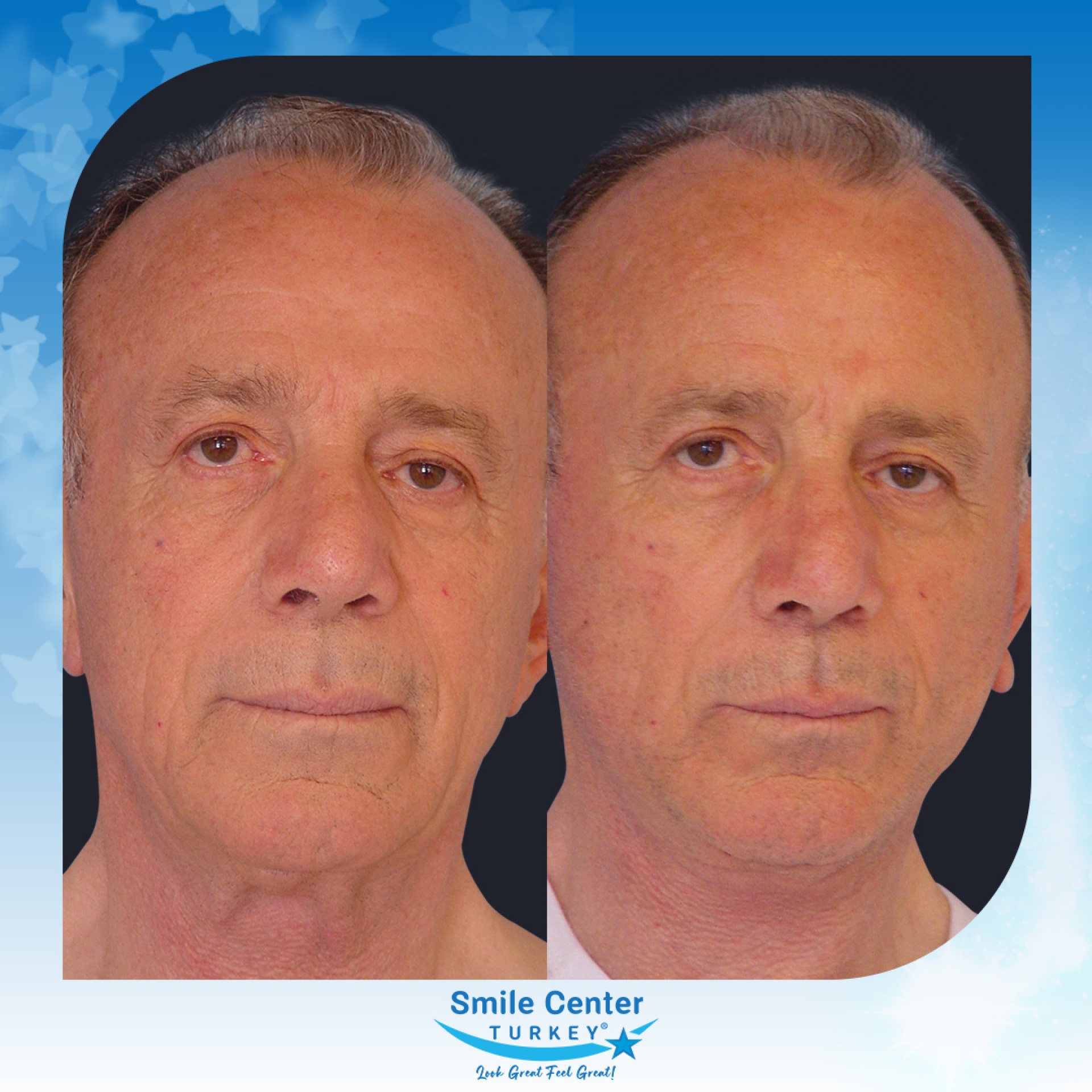Before and after cosmetic surgery at Smile Center Turkey