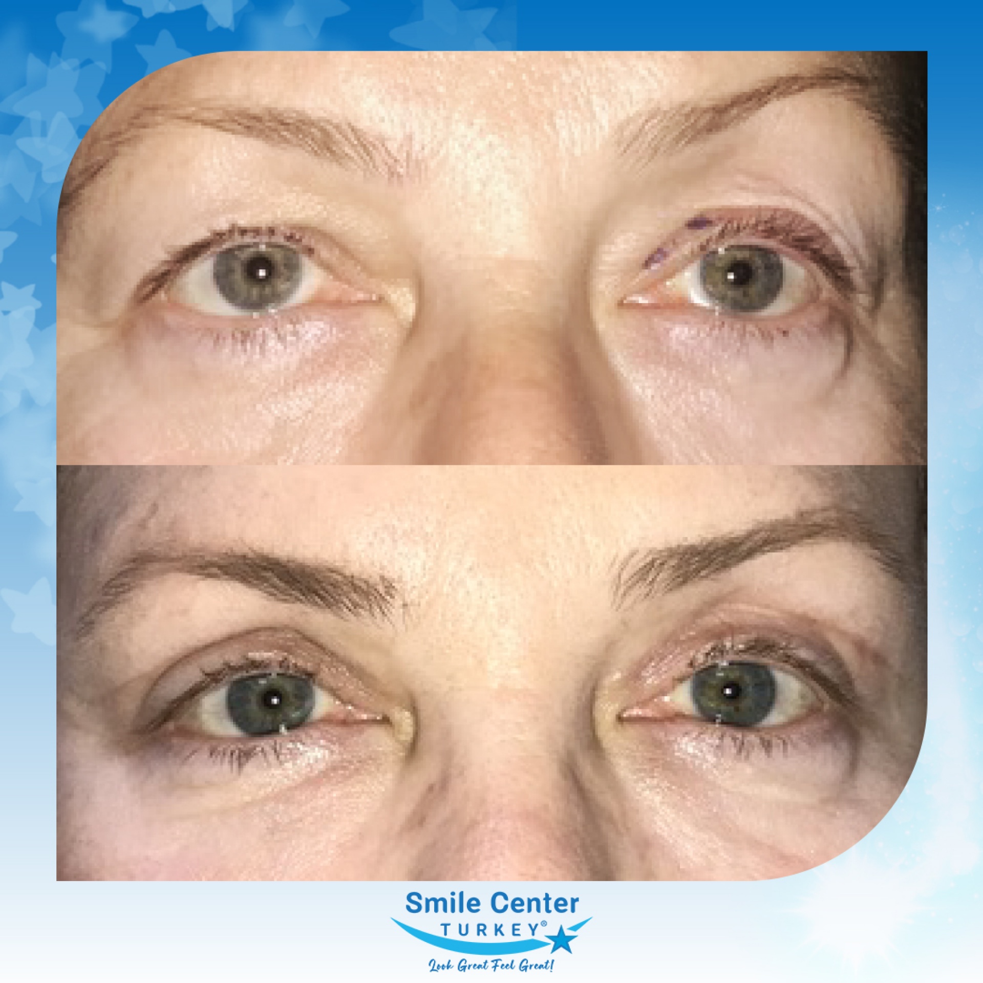 Before and after cosmetic surgery at Smile Center Turkey
