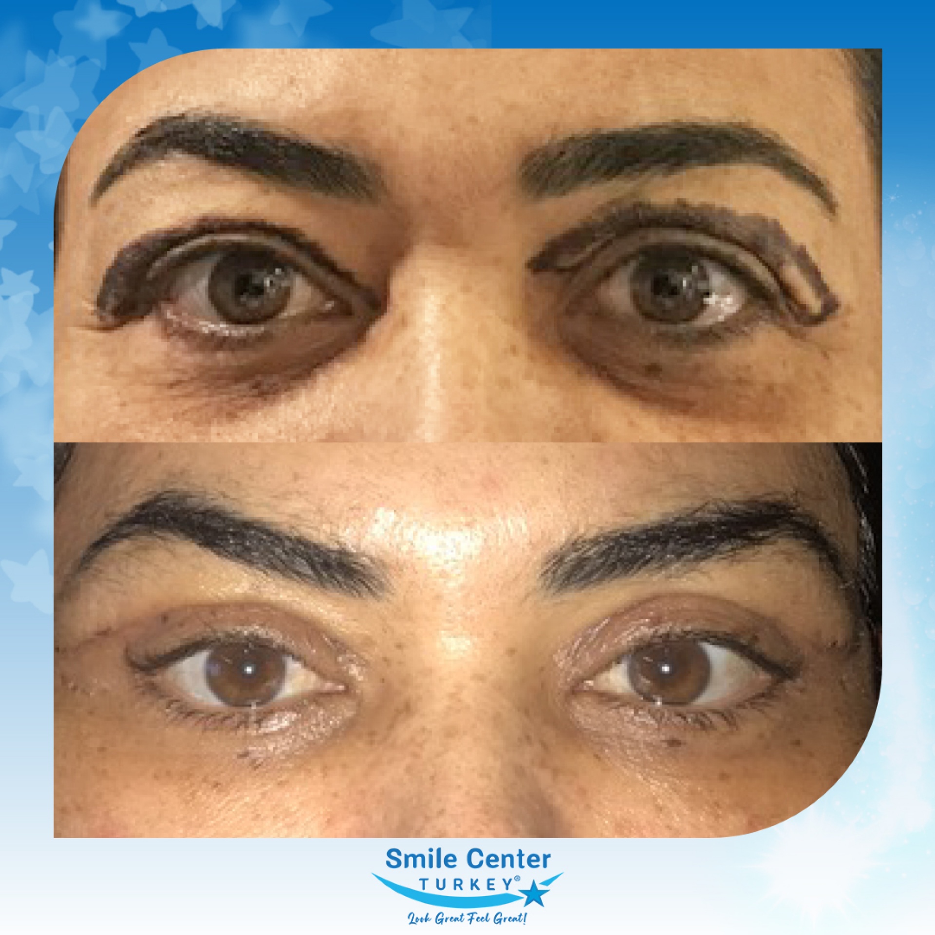 Before and after cosmetic surgery at Smile Center Turkey
