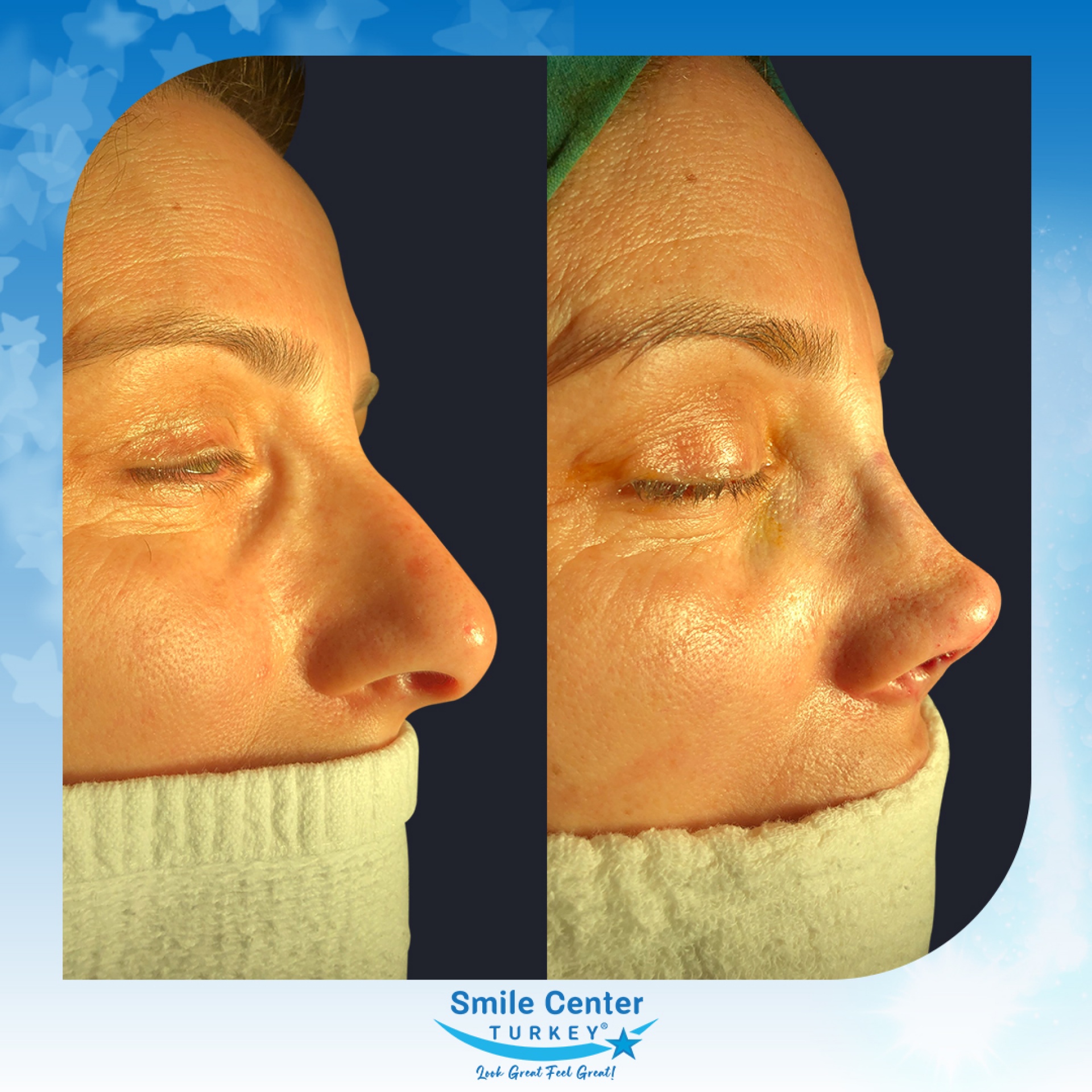 Before and after cosmetic surgery at Smile Center Turkey