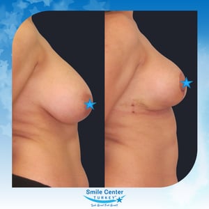 Before and after cosmetic surgery at Smile Center Turkey
