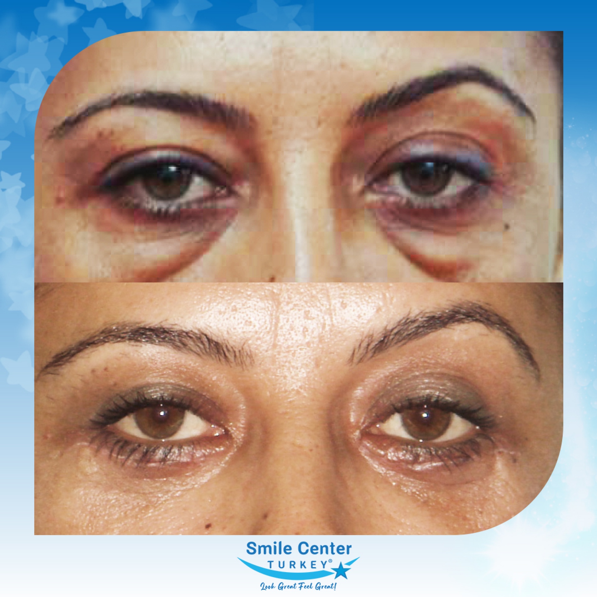 Before and after cosmetic surgery at Smile Center Turkey