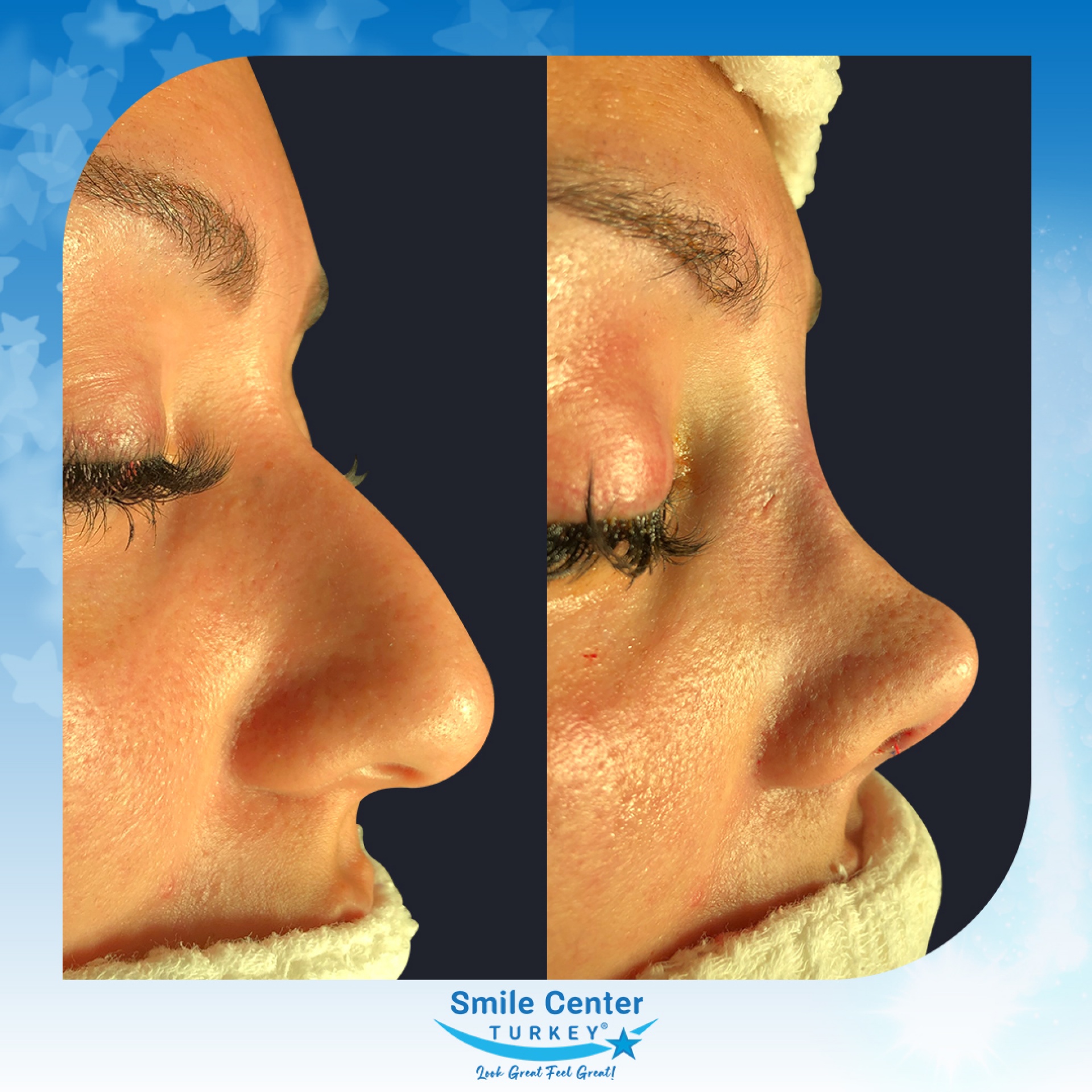 Before and after cosmetic surgery at Smile Center Turkey