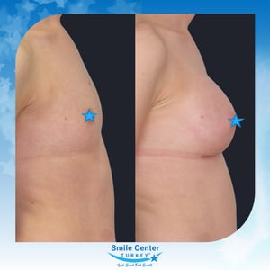 Before and after cosmetic surgery at Smile Center Turkey