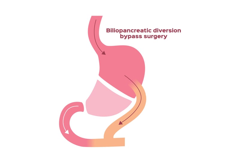 Biliopancreatic,Diversion,Bypass,Surgery,Vector