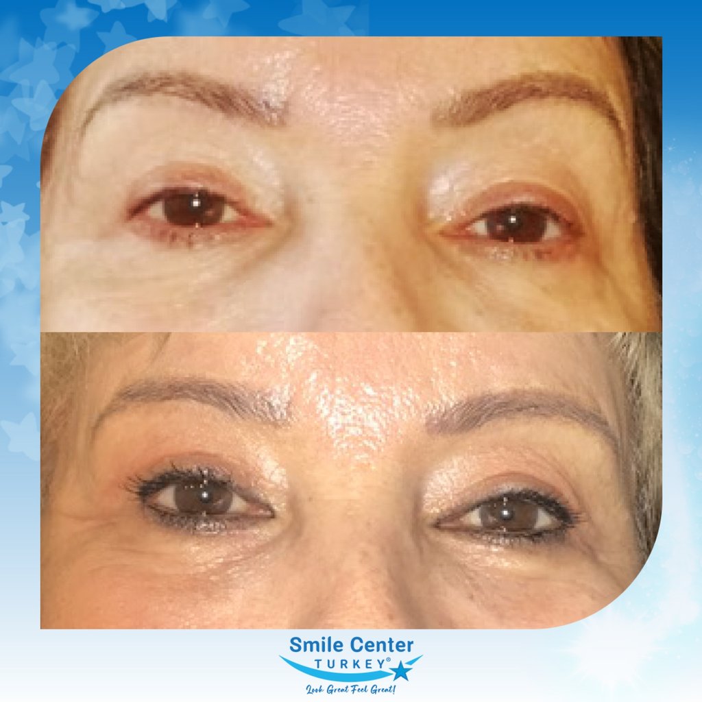 Before and after cosmetic surgery at Smile Center Turkey