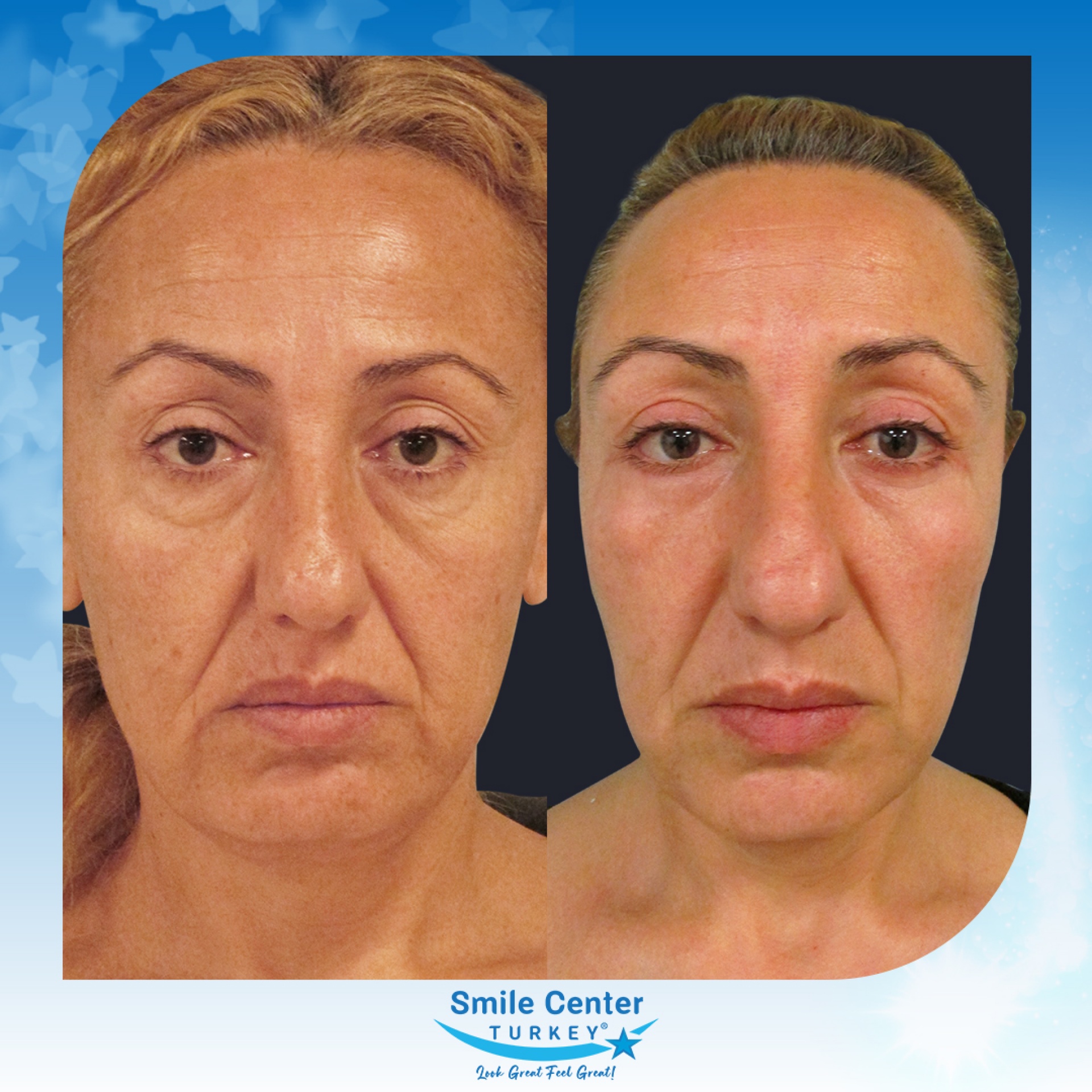 Before and after cosmetic surgery at Smile Center Turkey