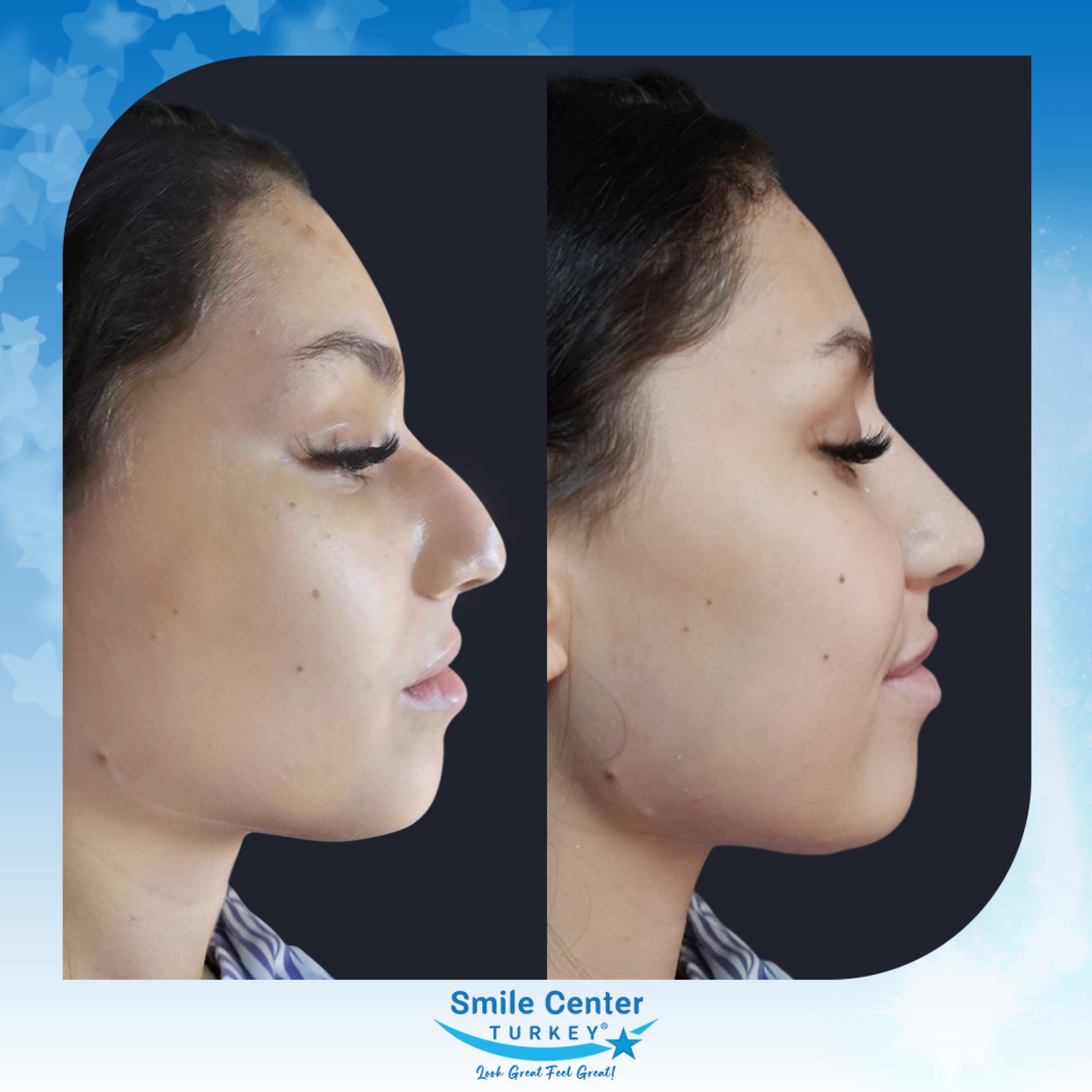 Before and after cosmetic surgery at Smile Center Turkey