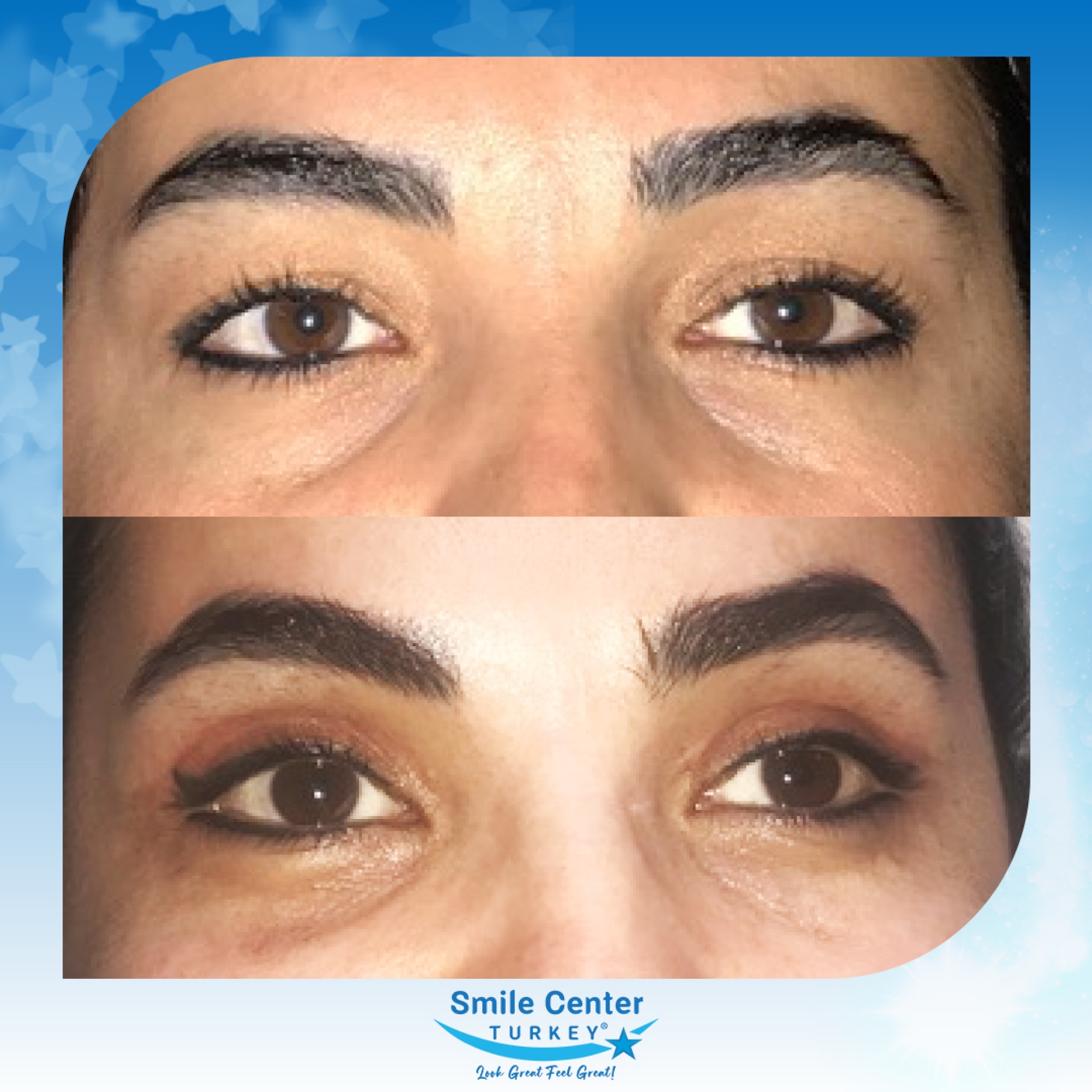 Before and after cosmetic surgery at Smile Center Turkey