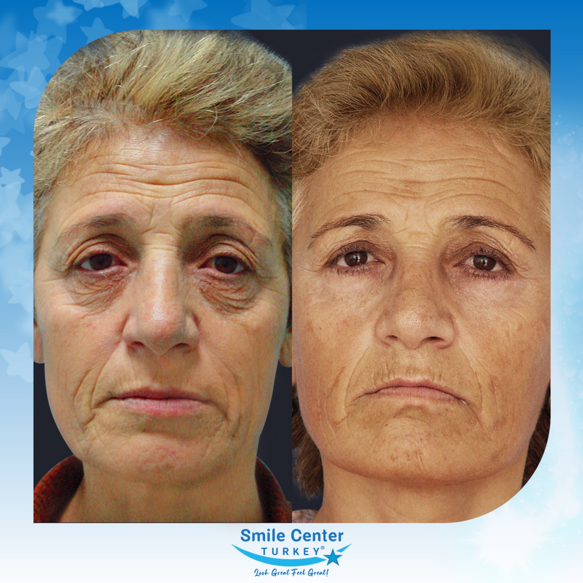 Before and after cosmetic surgery at Smile Center Turkey