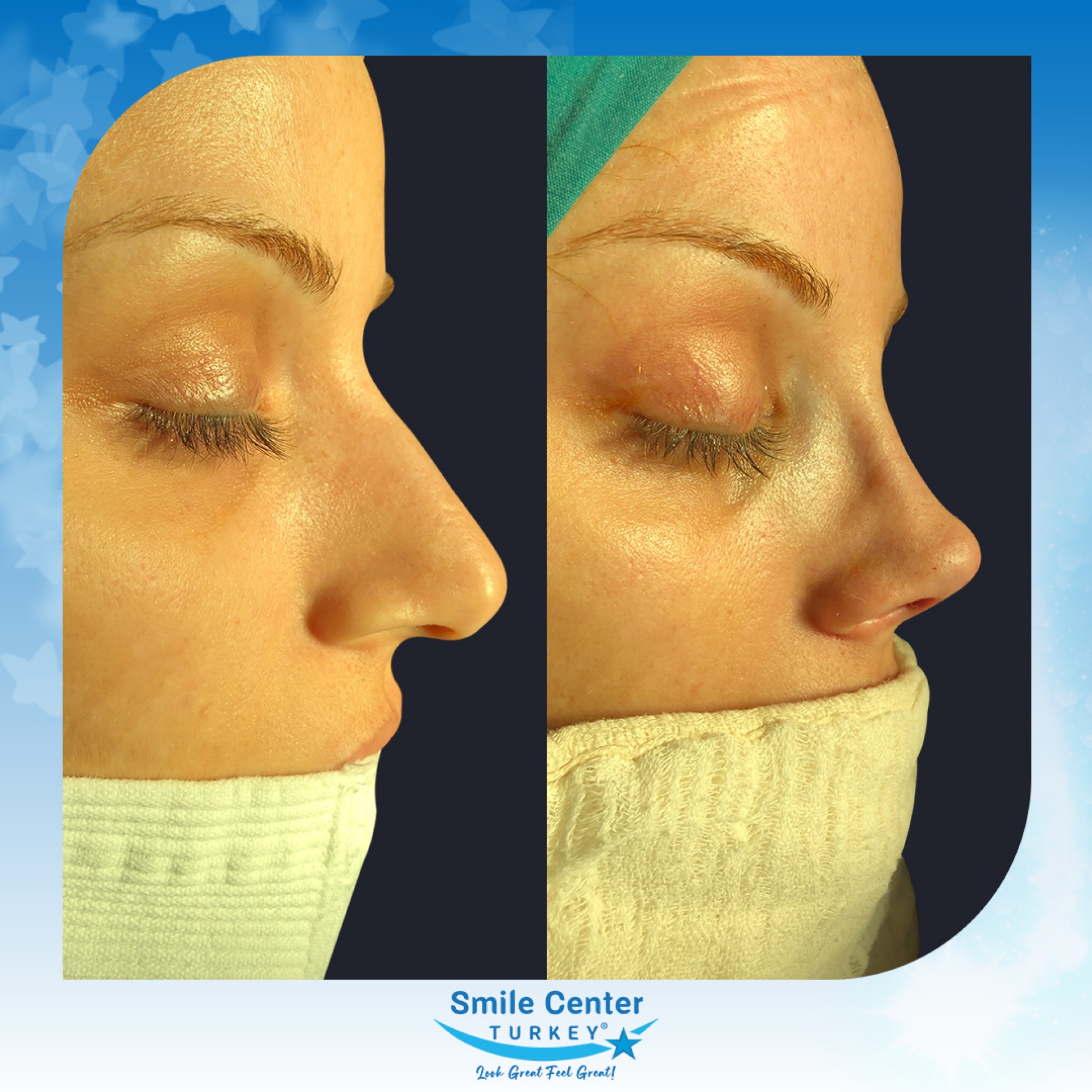 Before and after cosmetic surgery at Smile Center Turkey