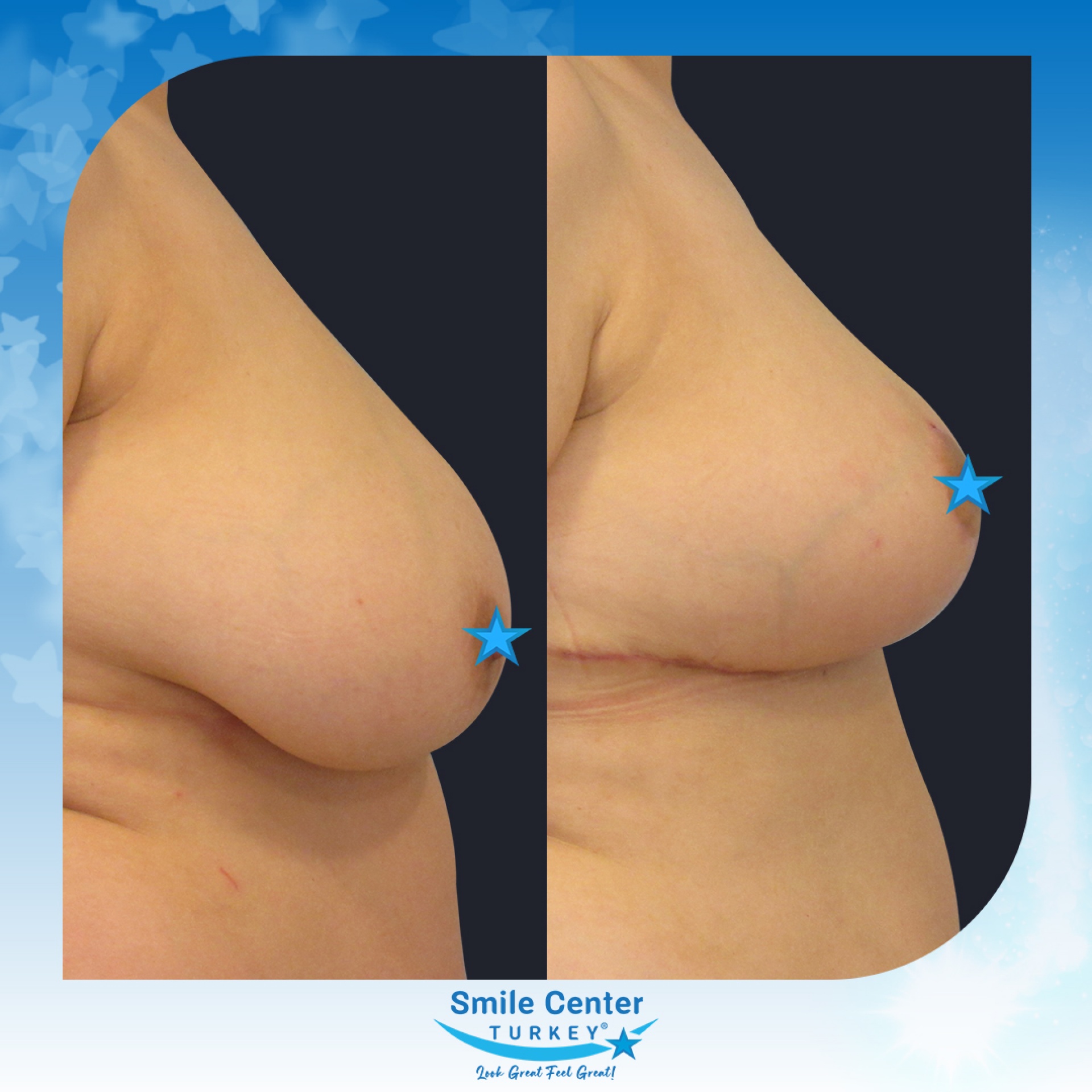 Before and after cosmetic surgery at Smile Center Turkey