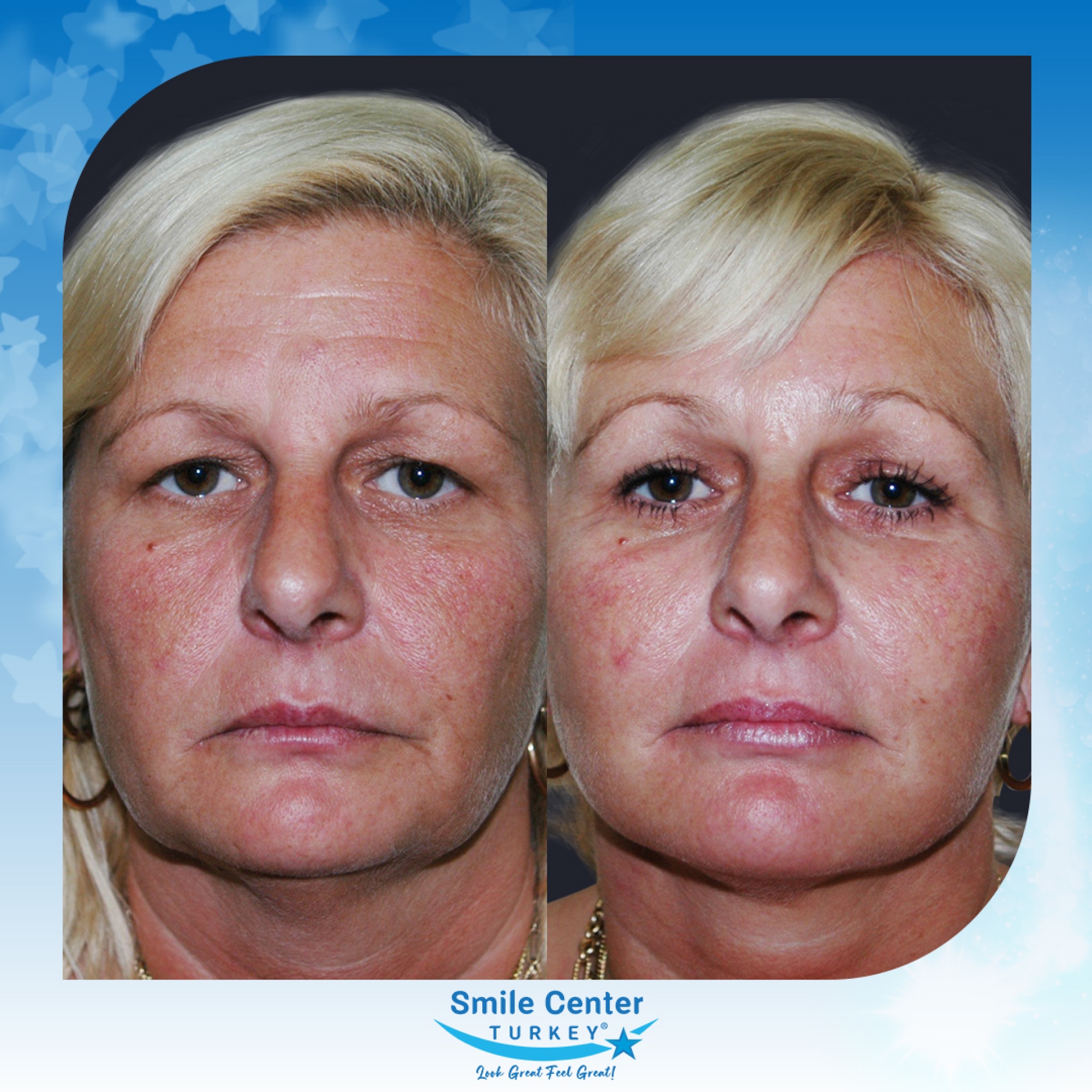 Before and after cosmetic surgery at Smile Center Turkey