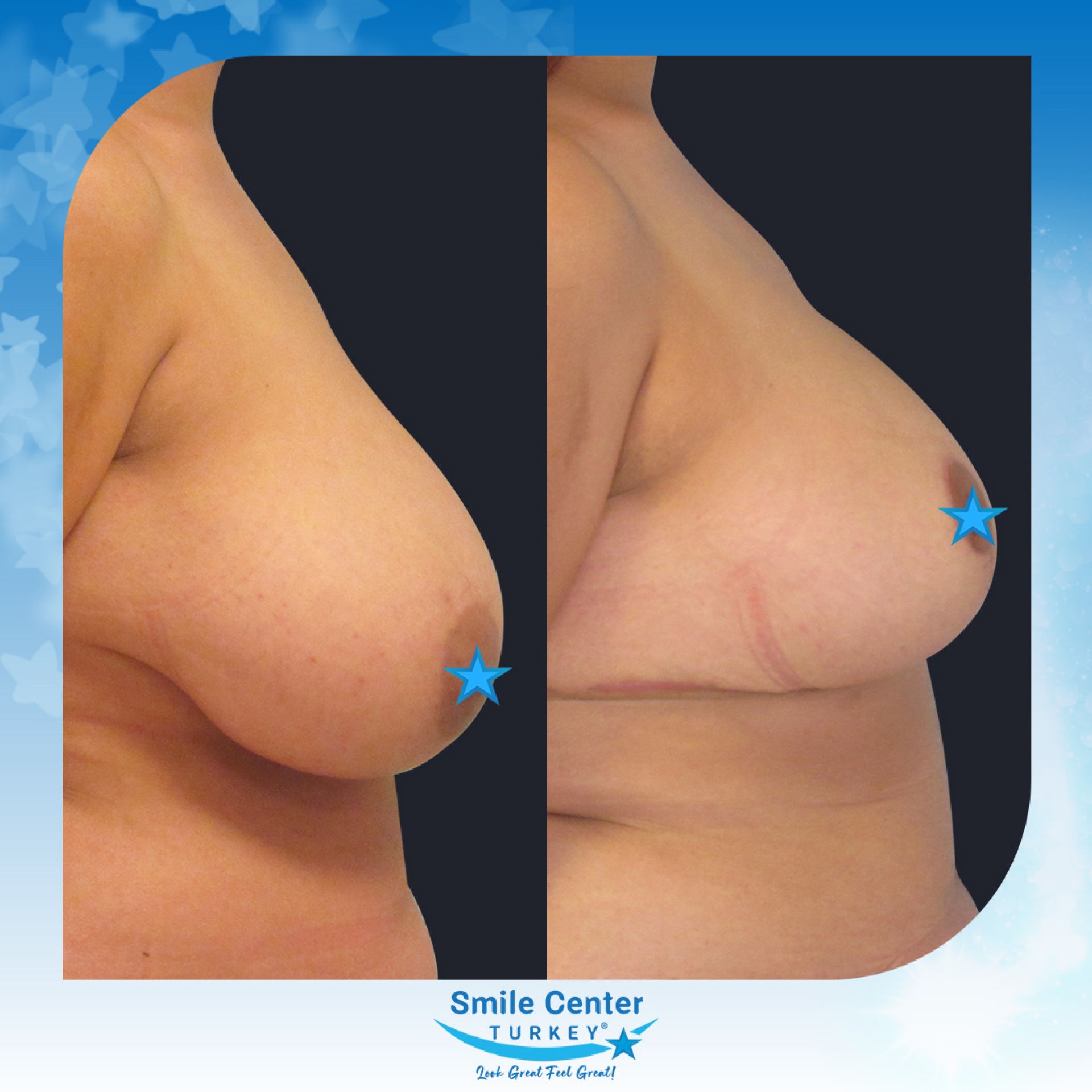 Before and after cosmetic surgery at Smile Center Turkey