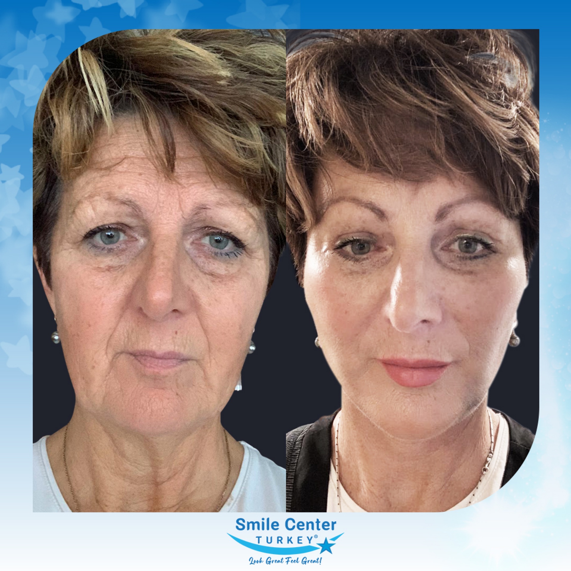 Before and after cosmetic surgery at Smile Center Turkey
