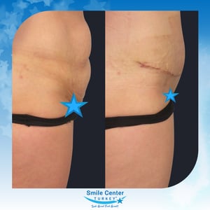 Before and after cosmetic surgery at Smile Center Turkey