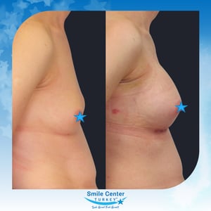 Before and after cosmetic surgery at Smile Center Turkey