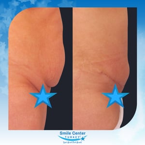 Before and after cosmetic surgery at Smile Center Turkey