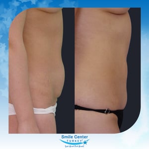 Before and after cosmetic surgery at Smile Center Turkey